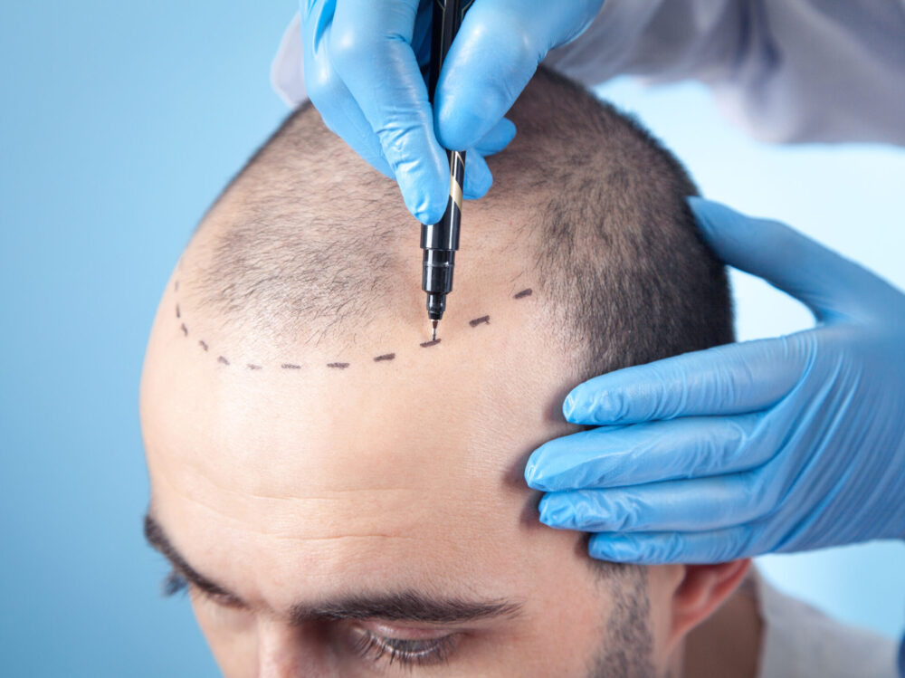 Patient suffering from hair loss in consultation with a doctor. Doctor using skin marker